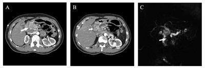 Case report and literature analysis: pancreatic hepatoid carcinoma with multiple lymph node metastases progressing to liver metastasis after pancreaticoduodenectomy